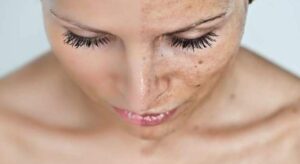 MITOS Y VERDADES SOBRE LAS MANCHAS EN EL ROSTRO